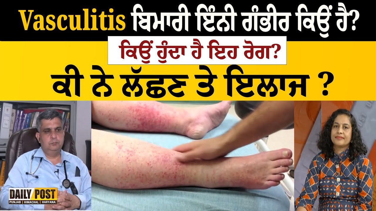 Awareness Program on Vasculitis — Daily Post Channel, August 2024