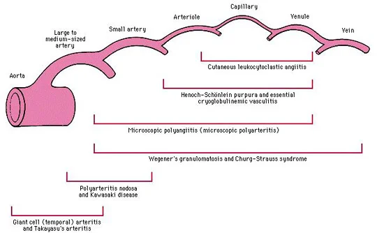 Types of Vasculitis by size of vasculature